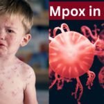 MPOX
