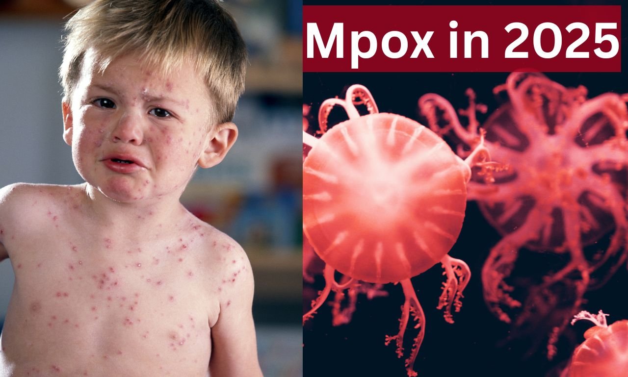 MPOX